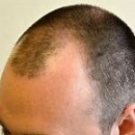 ケフトル ローション EX 薄毛 抜け毛 の 育毛剤 効果